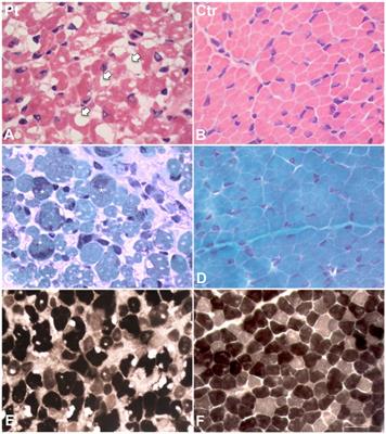 Case report: A novel ACTA1 variant in a patient with nemaline rods and increased glycogen deposition